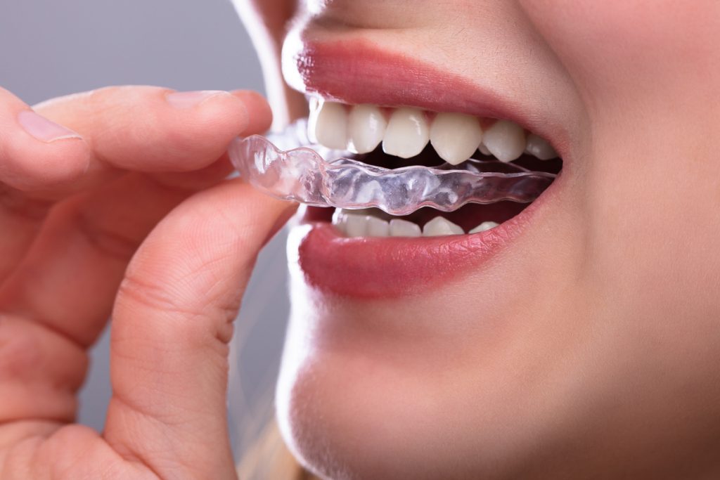 Una donna inserisce un bite dentale invisibile - Primo piano