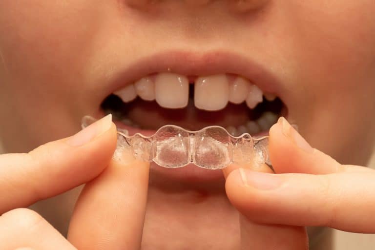 Frau setzt unsichtbare Zahnspange ein - wie funktioniert Invisalign?