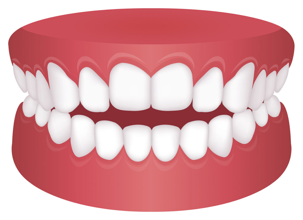 Nauwkeurig voorspelling welzijn Scheve tanden: Kan een onzichtbare beugel helpen?