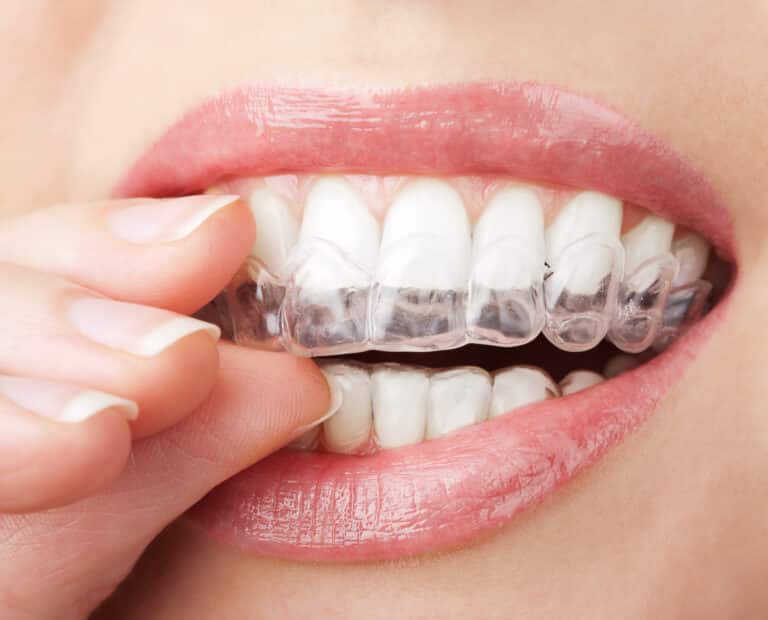 Junge Frau setzt Aligner ein - Invisalign i7