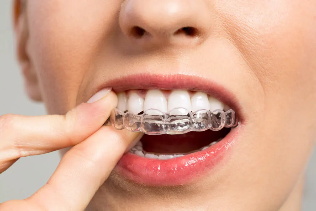 DrSmile före/efter bilder - Kvinna placerar tandställningen i munnen