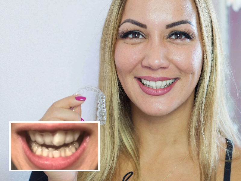 DrSmile vorher/nachher Bilder: Schiefe Zähne durch Engstand und Platzmangel