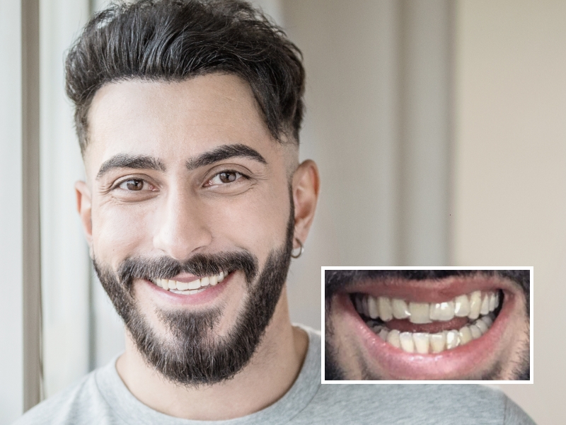 Images DrSmile avant après : Espace entre les dents (diastème)