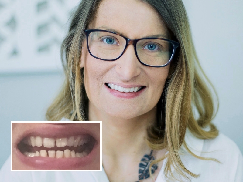 DrSmile före och efter bilder: Tandläckage (diastema)