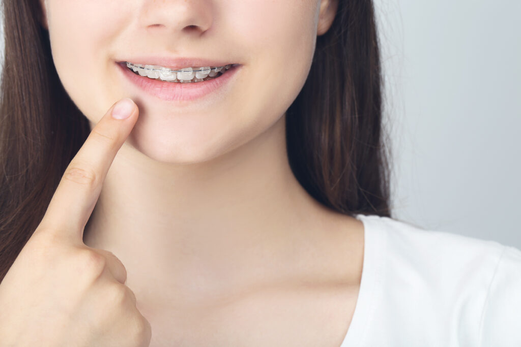 Young Girl Pointing on her Teeth - Soft Foods for Braces