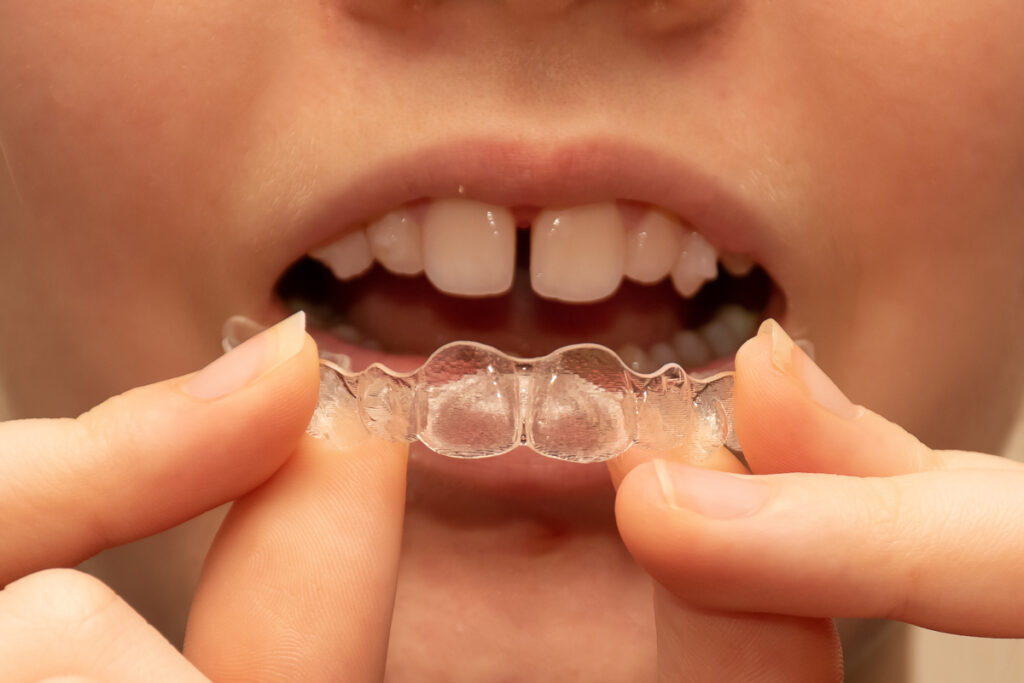 Vrouw met een spleetje tussen haar tanden gebruikt aligners.
De psychologische effecten van scheve tanden 