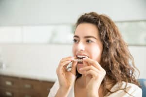 Junge Frau setzt Aligner ein - Invisalign Behandlungsdauer