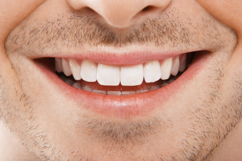 Young man smiling - Closeup. Clear Braces vs Metal Braces