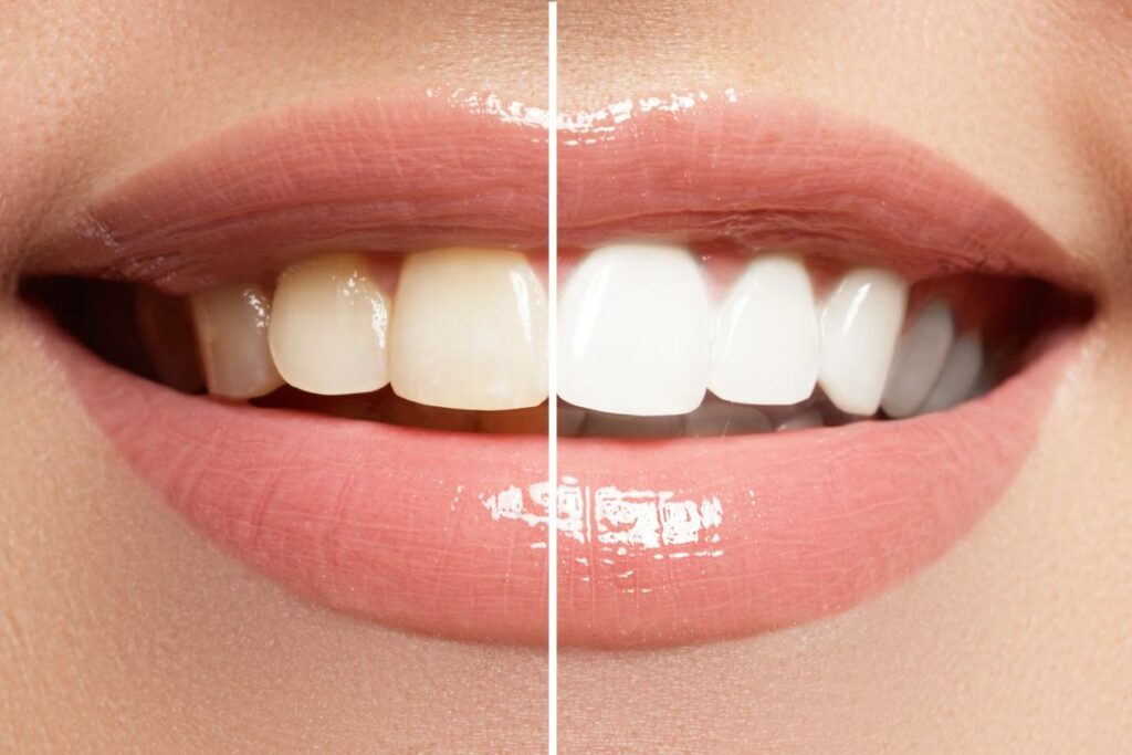 Teeth whitening before and after