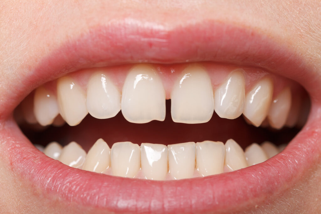 Une femme sourit à la caméra avec un espace entre les dents - Correction des gencives