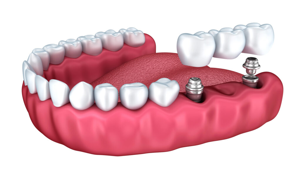 Puentes dentales: tipos, procedimiento, costes